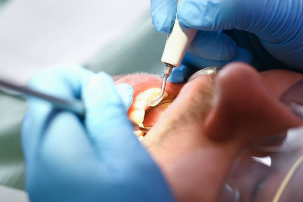 Best Emergency Root Canal Treatment in Island Lake, IL